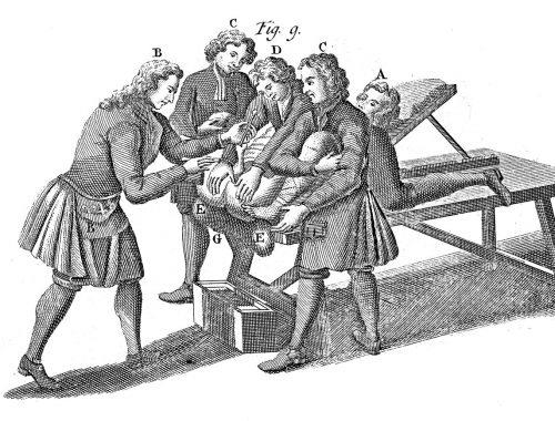 Lithotomy alebo Litotómia